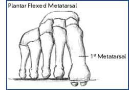 dropped hammer test medial|Metatarsalgia .